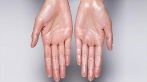 كيفية علاج تعرق اليدين بالطرق الطبية والطبيعية
